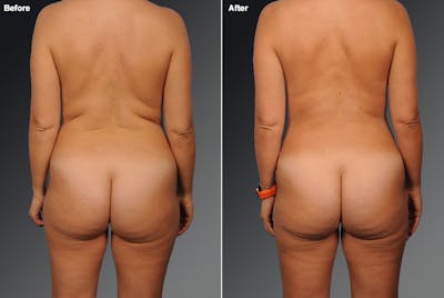 Liposuction Before & After Gallery - Patient 106009108 - Image 1