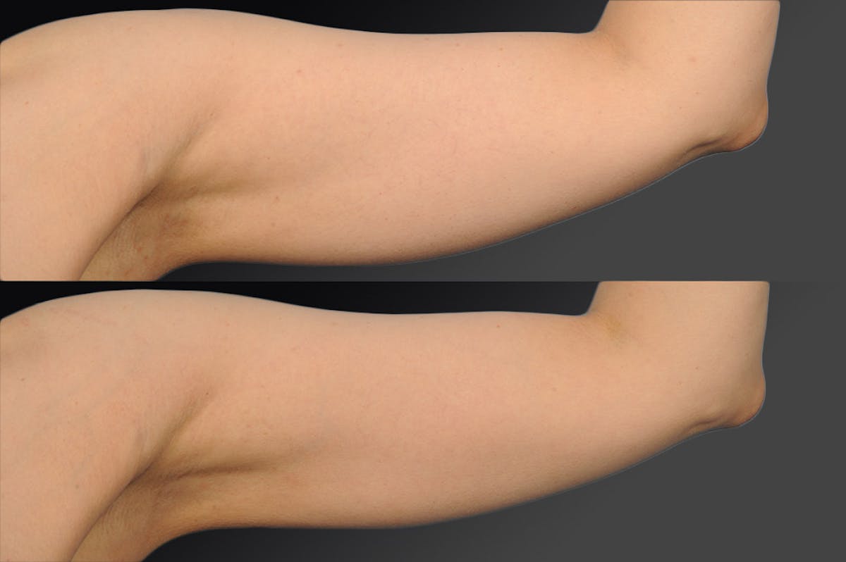 Liposuction Before & After Gallery - Patient 106009110 - Image 1