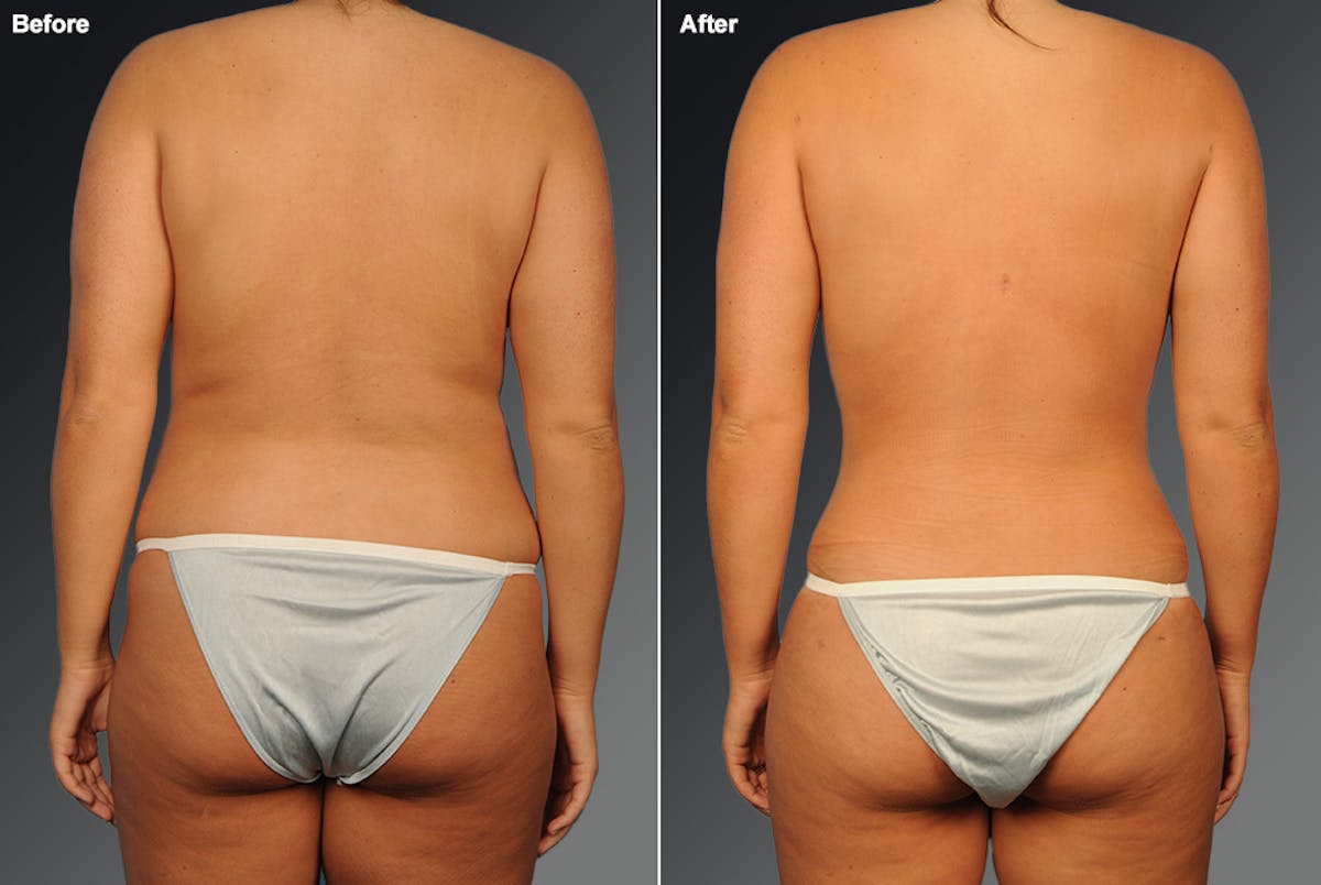 Liposuction Before & After Gallery - Patient 106009111 - Image 1