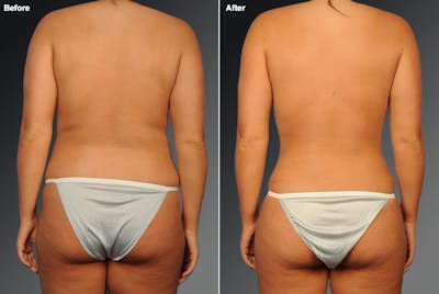 Liposuction Before & After Gallery - Patient 106009111 - Image 1