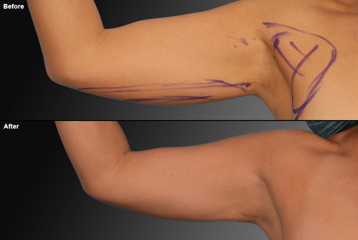 Liposuction Before & After Gallery - Patient 106009112 - Image 1