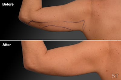 Liposuction Before & After Gallery - Patient 106009113 - Image 1