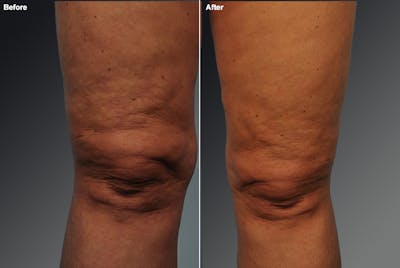Liposuction Before & After Gallery - Patient 106009117 - Image 1
