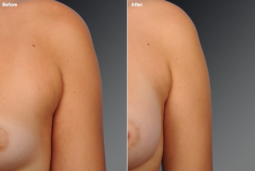 Liposuction Before & After Gallery - Patient 106009118 - Image 1