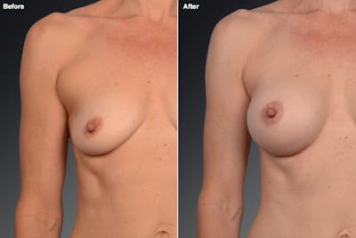 Liposuction Before & After Gallery - Patient 106009119 - Image 1