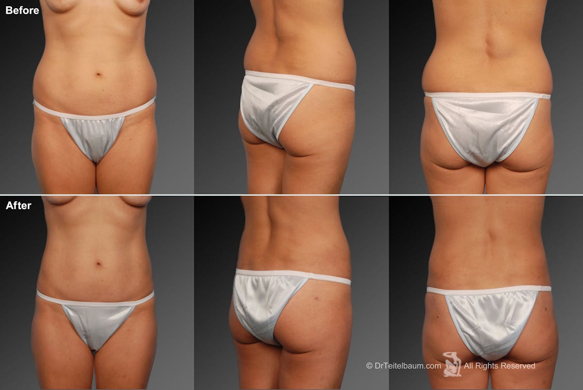 Liposuction Before & After Gallery - Patient 106009120 - Image 1