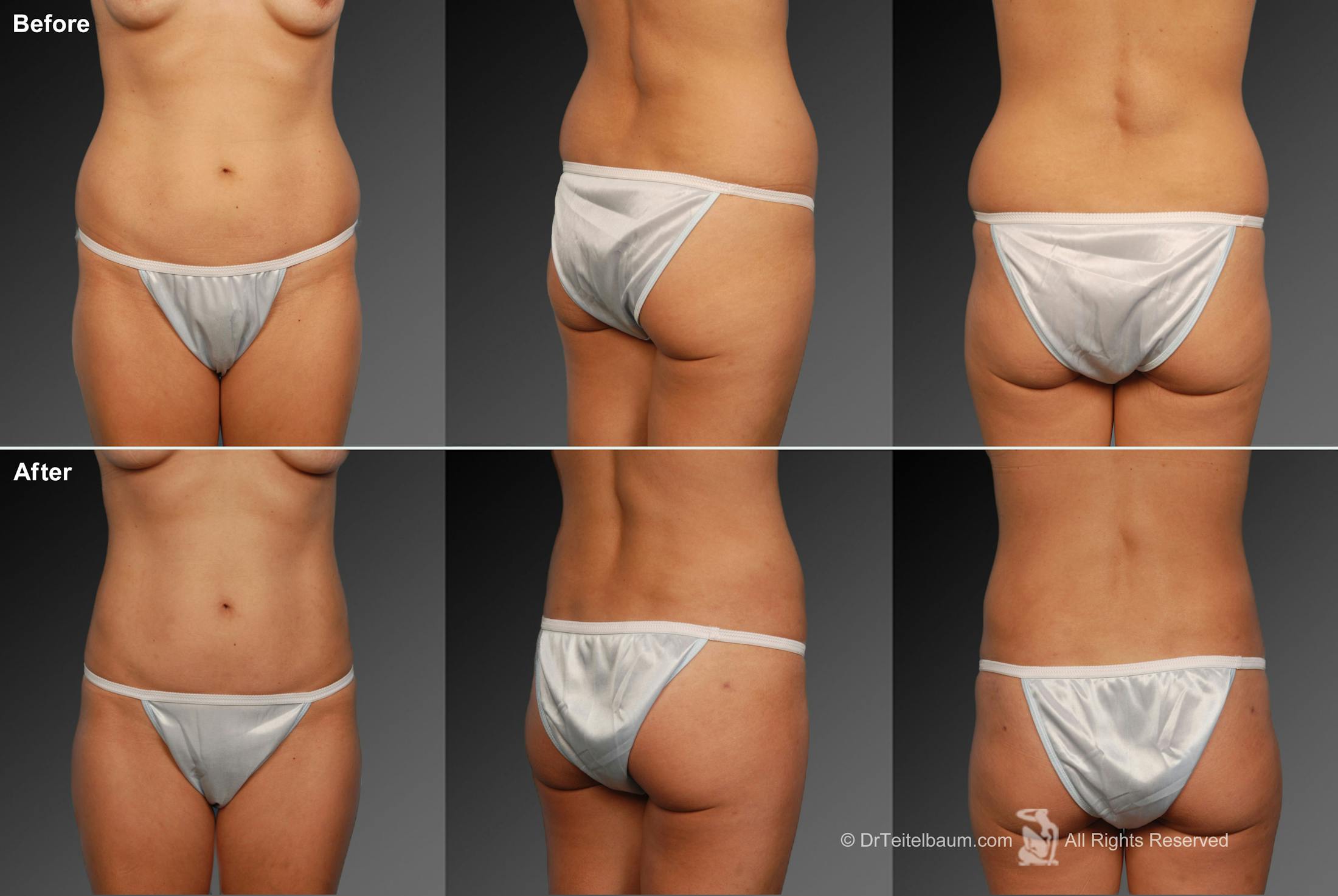 Liposuction Before & After Gallery - Patient 106009120 - Image 1
