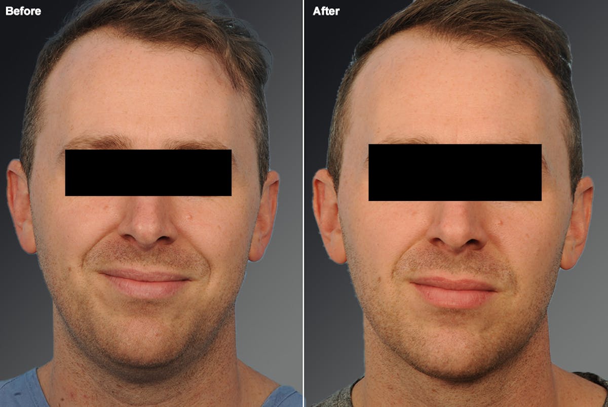 Face Before & After Gallery - Patient 948853 - Image 1