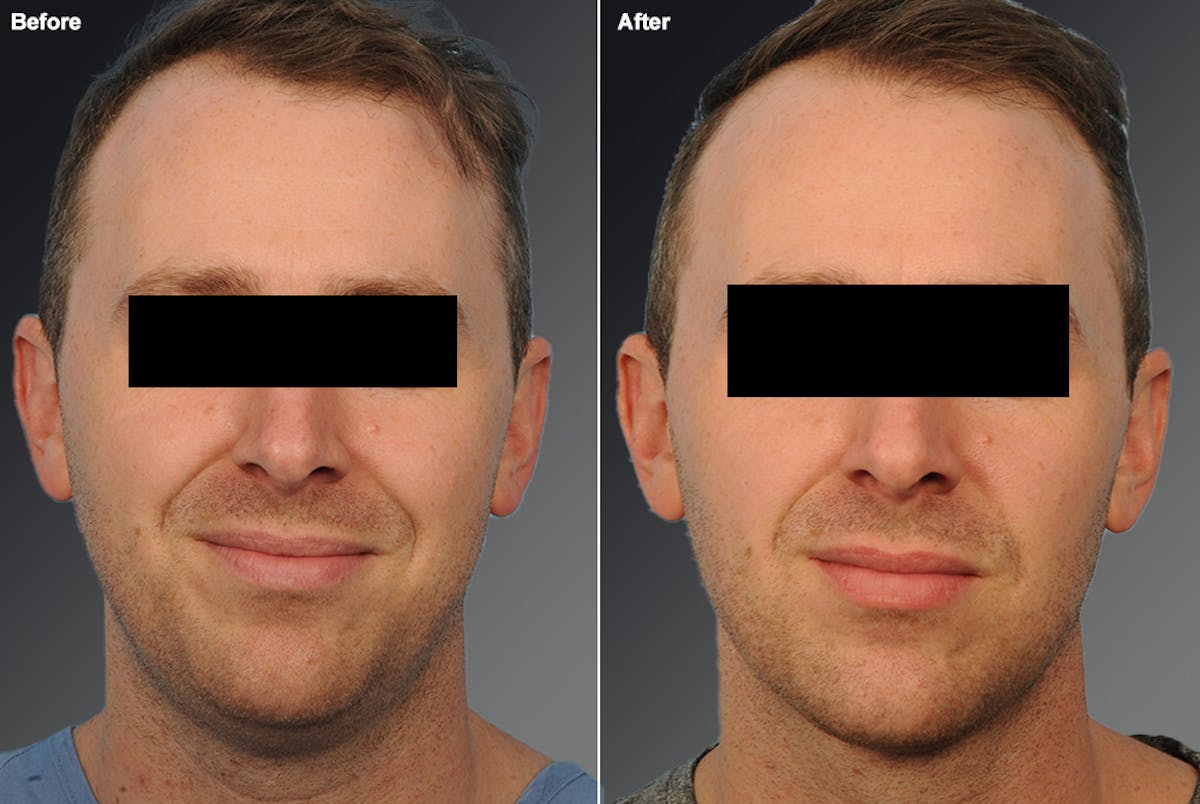 Liposuction Before & After Gallery - Patient 106009121 - Image 1