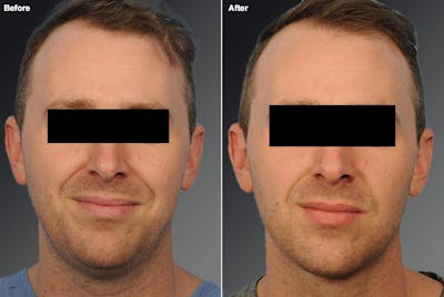 Face Before & After Gallery - Patient 948853 - Image 1