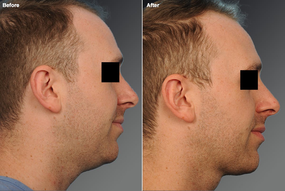 Face Before & After Gallery - Patient 922953 - Image 1