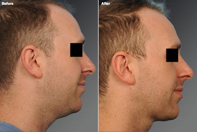 Face Before & After Gallery - Patient 922953 - Image 1