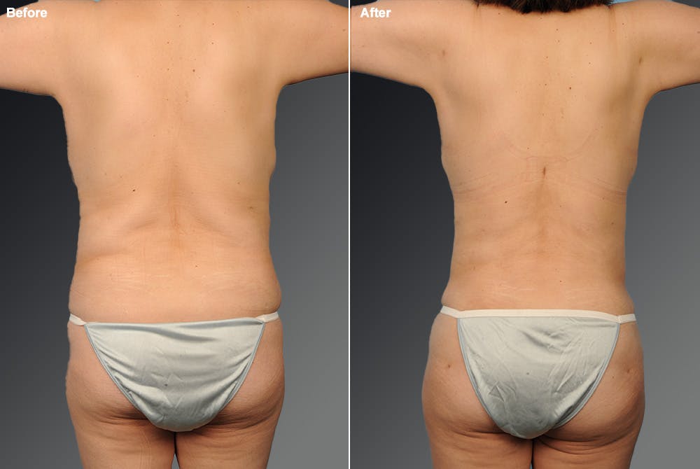 Liposuction Before & After Gallery - Patient 106009123 - Image 1