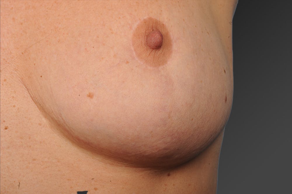 Body Scar Closeups Before & After Gallery - Patient 106009142 - Image 1
