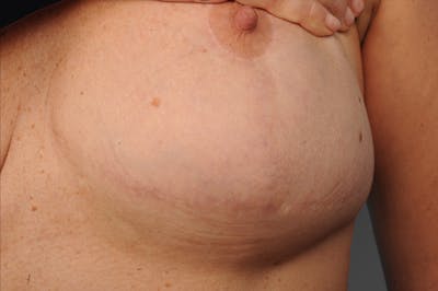 Body Scar Closeups Before & After Gallery - Patient 106009145 - Image 1