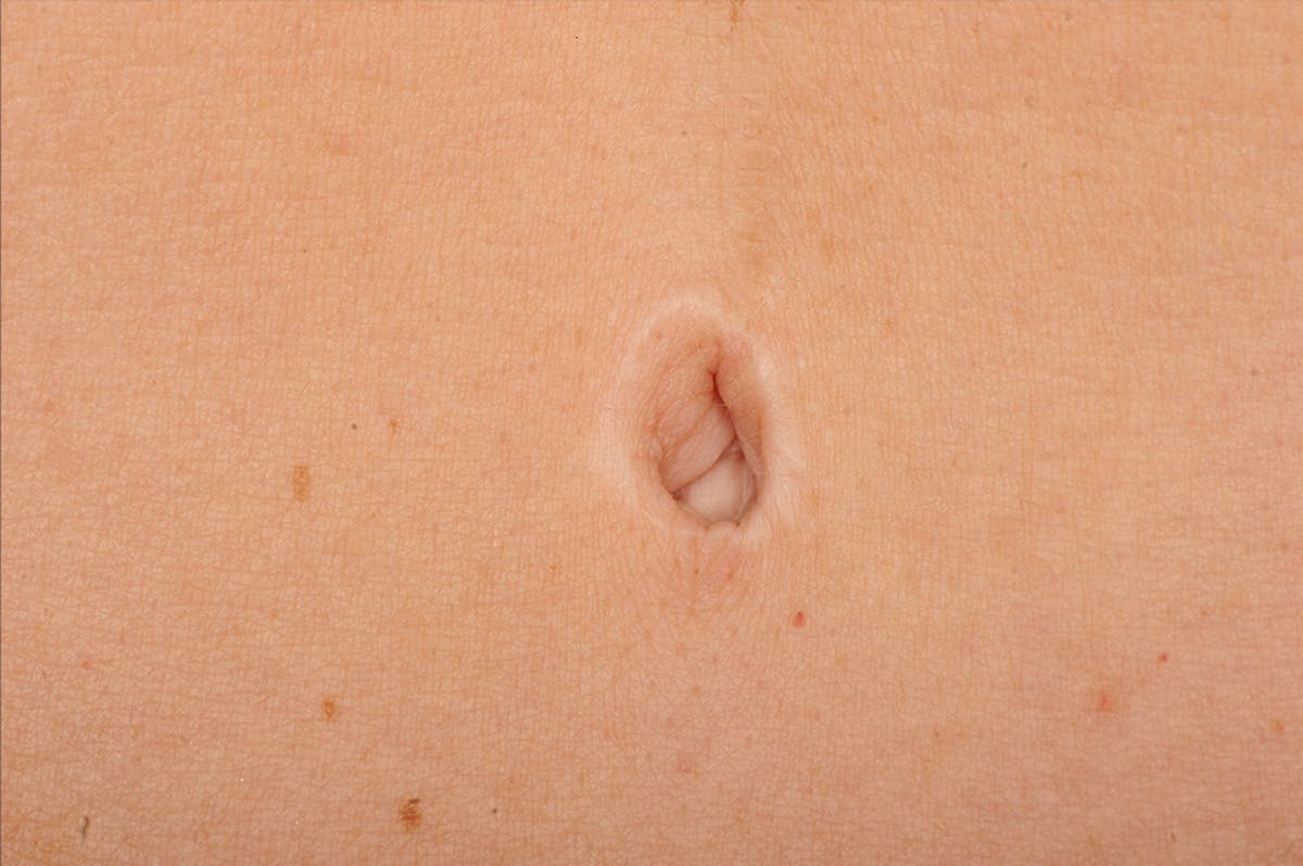 Body Scar Closeups Before & After Gallery - Patient 106009146 - Image 1