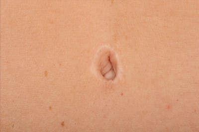 Body Scar Closeups Before & After Gallery - Patient 106009146 - Image 1
