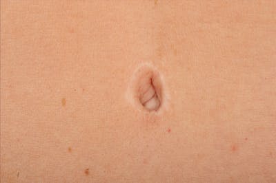 Body Scar Closeups Before & After Gallery - Patient 106009146 - Image 1