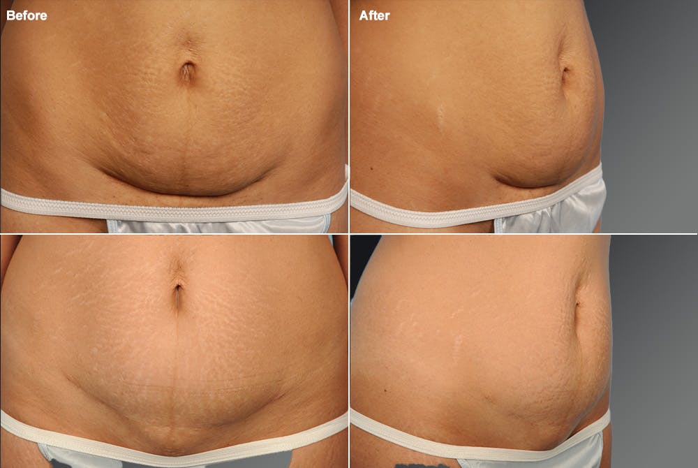 C-Section Scar Revision Before & After Gallery - Patient 114188441 - Image 1