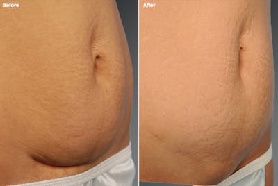C-Section Scar Revision Before & After Gallery - Patient 114188442 - Image 1