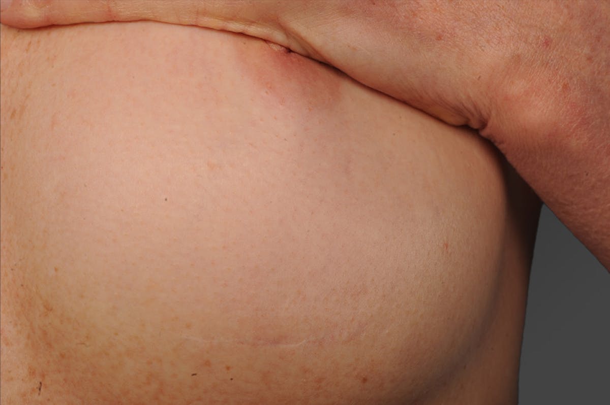 Body Scar Closeups Before & After Gallery - Patient 106009150 - Image 1
