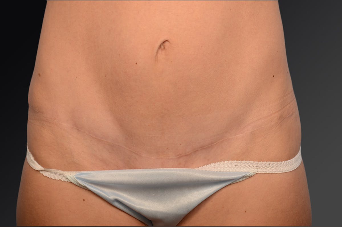 C-Section Scar Revision Before & After Gallery - Patient 114188445 - Image 1
