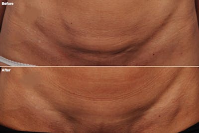 C-Section Scar Revision Before & After Gallery - Patient 114188447 - Image 1