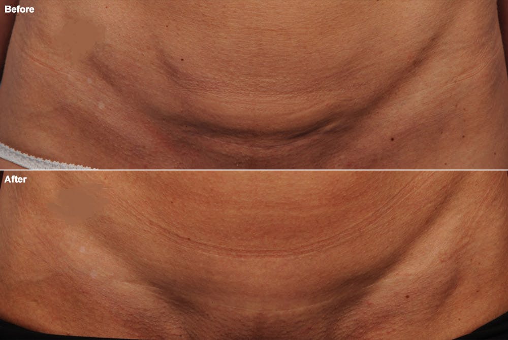 C-Section Scar Revision Before & After Gallery - Patient 114188447 - Image 1