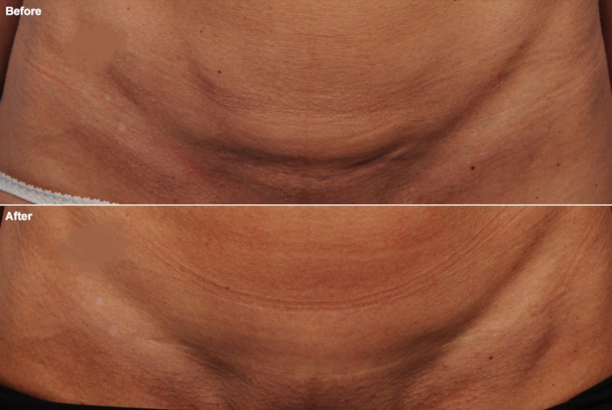 Body Scar Closeups Before & After Gallery - Patient 106009153 - Image 1