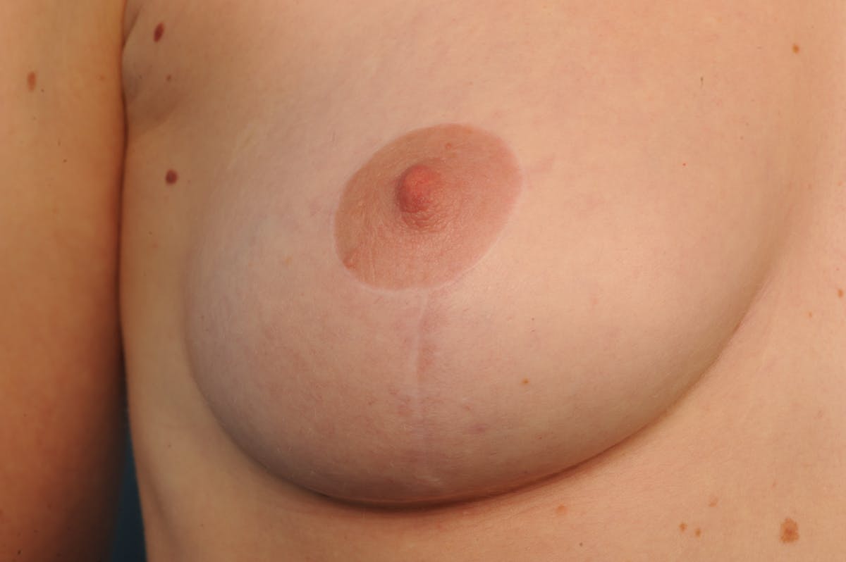 Body Scar Closeups Before & After Gallery - Patient 106009154 - Image 1