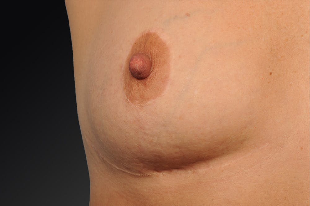 Body Scar Closeups Before & After Gallery - Patient 106009156 - Image 1