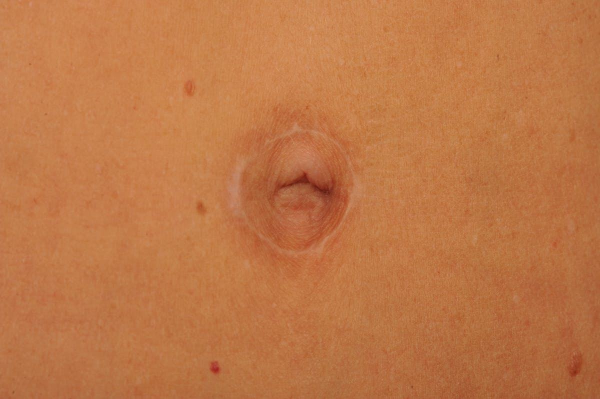 Body Scar Closeups Before & After Gallery - Patient 106009158 - Image 1