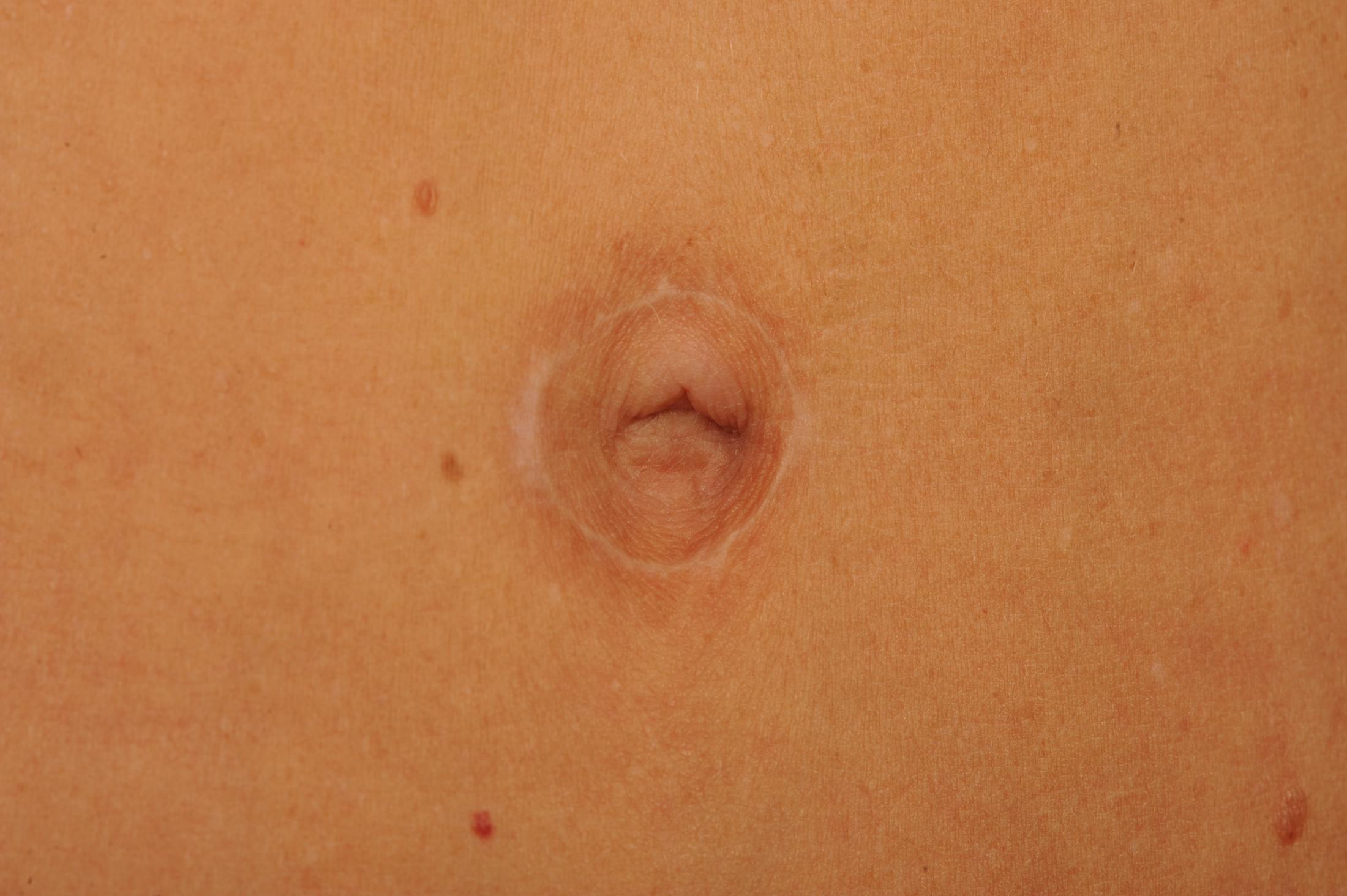 Body Scar Closeups Before & After Gallery - Patient 106009158 - Image 1