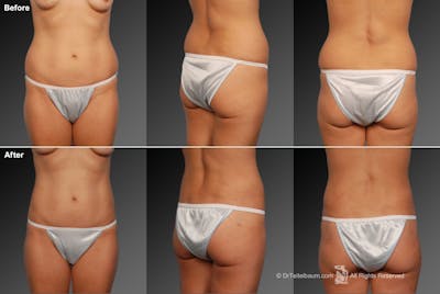 Liposuction Before & After Gallery - Patient 117349950 - Image 1