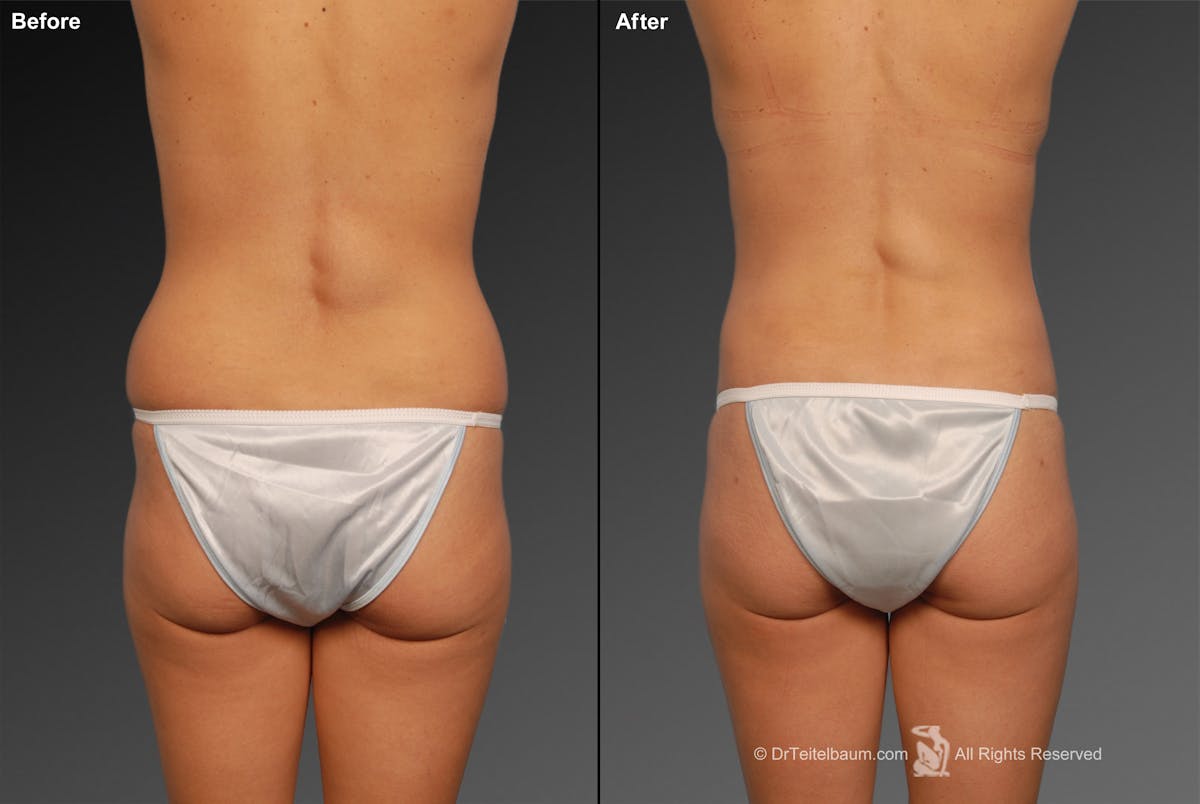 Liposuction Before & After Gallery - Patient 117349954 - Image 1