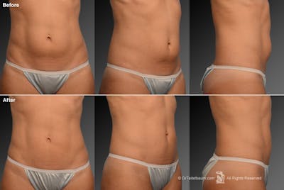 Liposuction Before & After Gallery - Patient 117349961 - Image 1