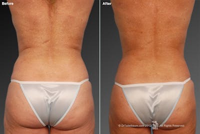 Liposuction Before & After Gallery - Patient 117349974 - Image 1