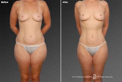 Liposuction Before & After Gallery - Patient 117349981 - Image 1
