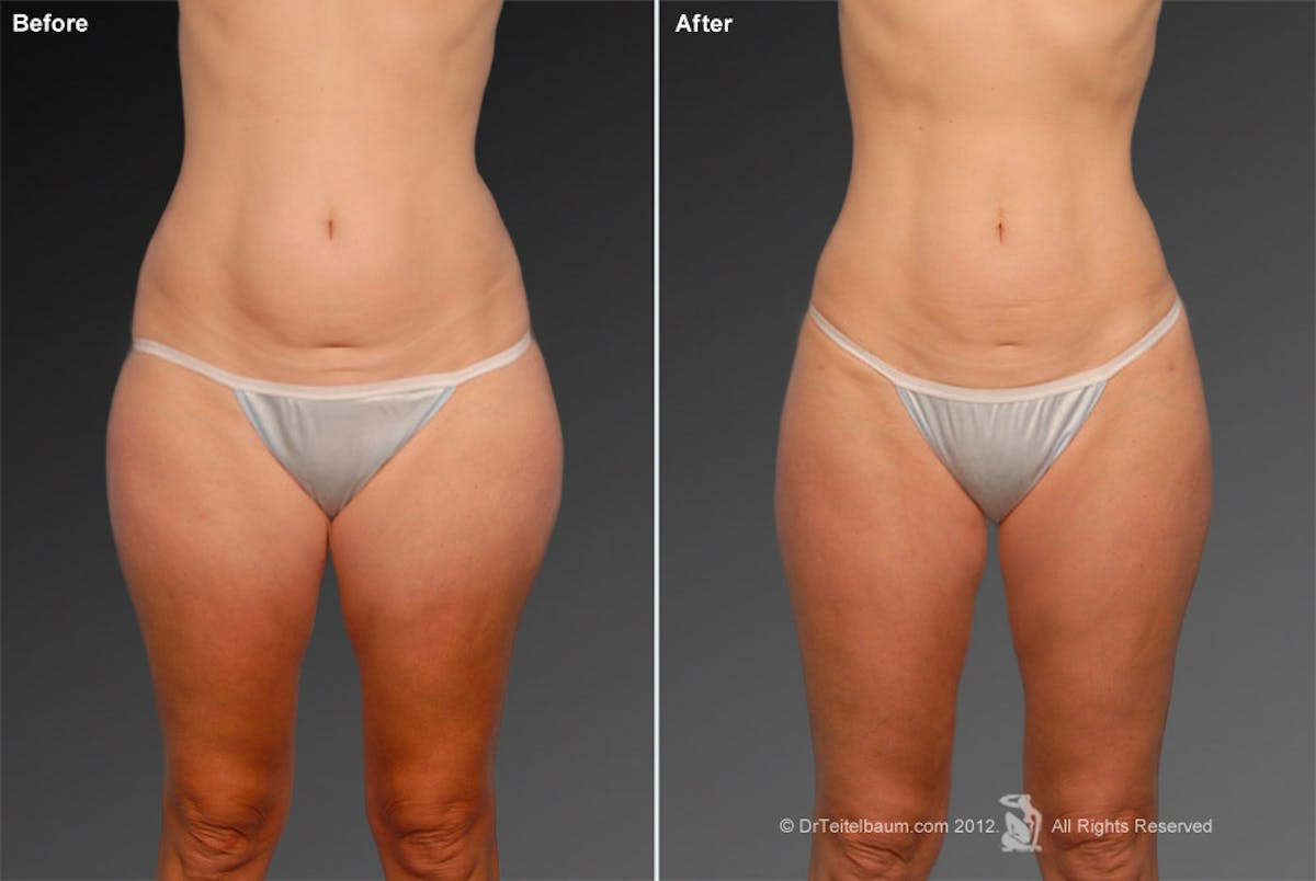 Liposuction Before & After Gallery - Patient 117349987 - Image 1