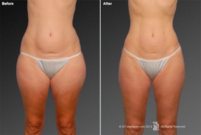 Liposuction Before & After Gallery - Patient 117349987 - Image 1