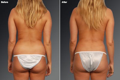 Liposuction Before & After Gallery - Patient 117349989 - Image 1
