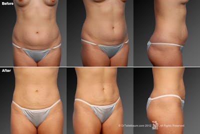 Tummy Tuck Before & After Gallery - Patient 117349991 - Image 1