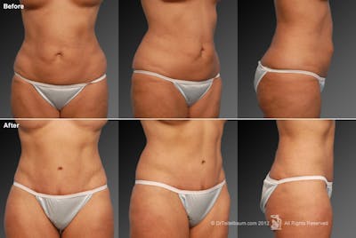 Tummy Tuck Before & After Gallery - Patient 117350005 - Image 1