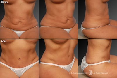 Tummy Tuck Before & After Gallery - Patient 118022988 - Image 1