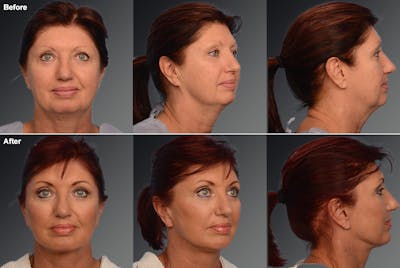 Face and Neck Lift Before & After Gallery - Patient 106009204 - Image 1