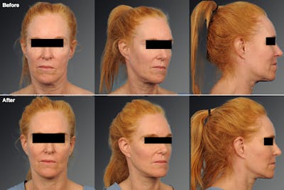 Face and Neck Lift Before & After Gallery - Patient 106009205 - Image 1