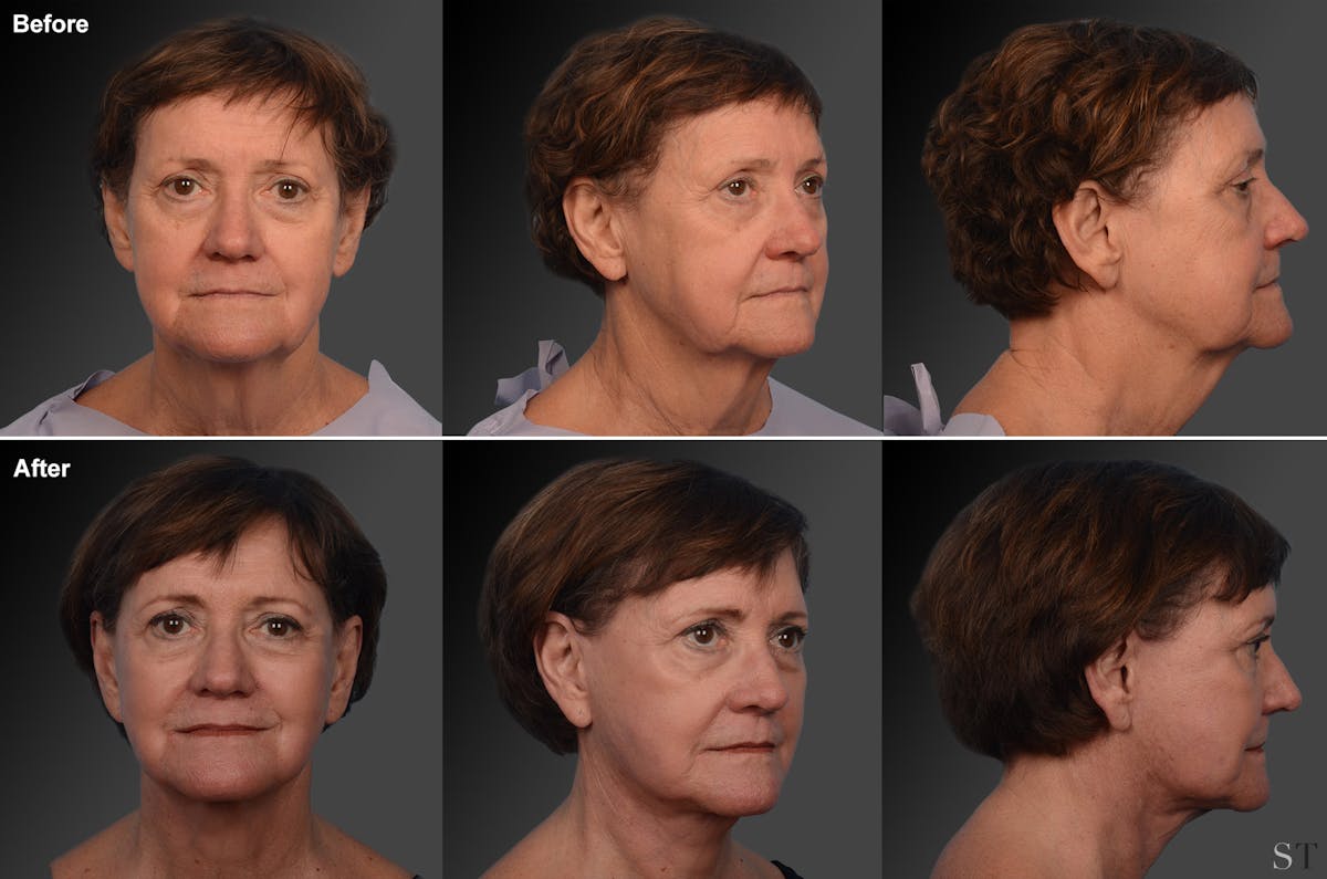 Face and Neck Lift Before & After Gallery - Patient 106009206 - Image 1