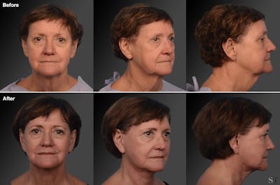 Face and Neck Lift Before & After Gallery - Patient 106009206 - Image 1