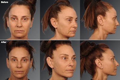 Face and Neck Lift Before & After Gallery - Patient 106009207 - Image 1