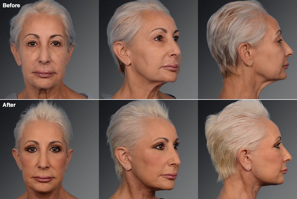 Face and Neck Lift Before & After Gallery - Patient 106009208 - Image 1